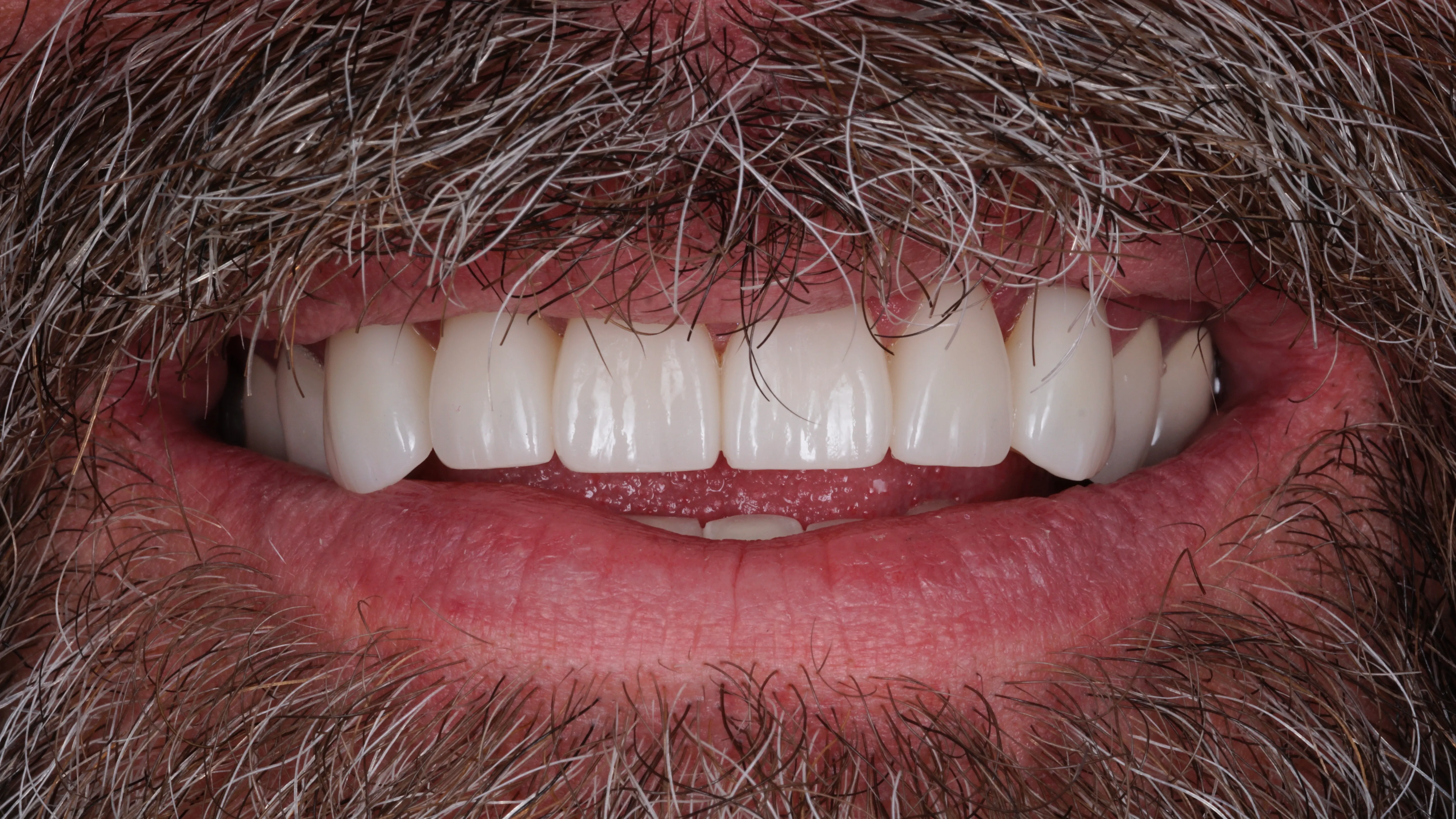 Finished smile after treatment